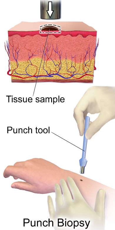 Aireys Inlet Skin Cancer Clinic - A Punch Biopsy